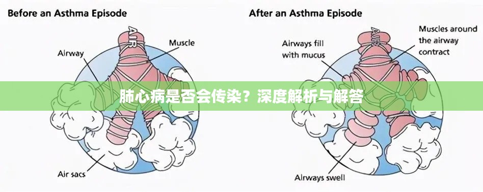 肺心病是否会传染？深度解析与解答